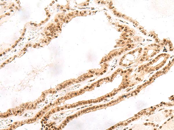 TOR1A / Torsin A Antibody - Immunohistochemistry of paraffin-embedded Human thyroid cancer tissue  using TOR1A Polyclonal Antibody at dilution of 1:30(×200)