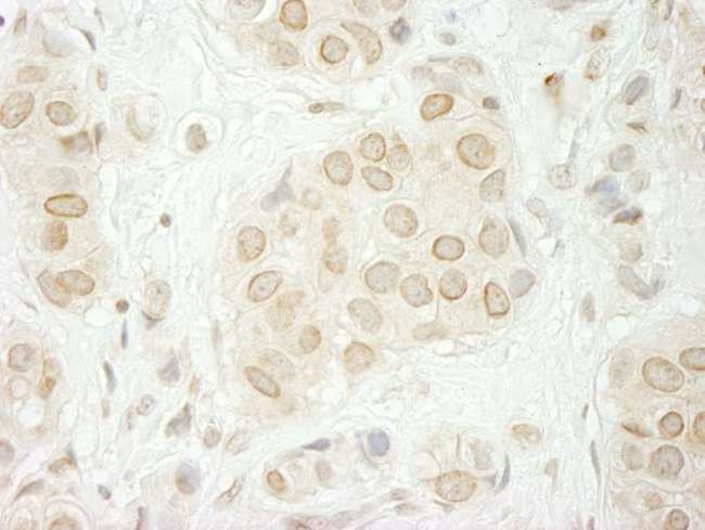 TOR1AIP1 / LAP1 Antibody - Detection of Human LAP1B Immunohistochemistry. Sample: FFPE section of human breast carcinoma. Antibody: Affinity purified rabbit anti-LAP1B used at a dilution of 1:250.