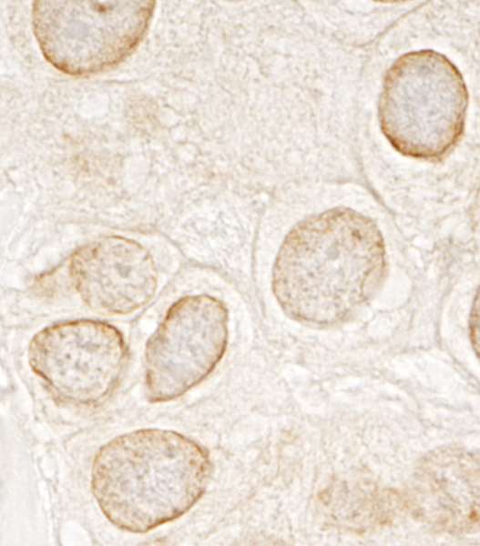 TOR1AIP1 / LAP1 Antibody - Detection of Human LAP1B by Immunohistochemistry. Sample: FFPE section of human breast carcinoma. Antibody: Affinity purified rabbit anti-LAP1B used at a dilution of 1:200 (1 Detection: DAB.