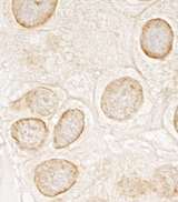TOR1AIP1 / LAP1 Antibody - Detection of Human LAP1B by Immunohistochemistry. Sample: FFPE section of human breast carcinoma. Antibody: Affinity purified rabbit anti-LAP1B used at a dilution of 1:200 (1 Detection: DAB.