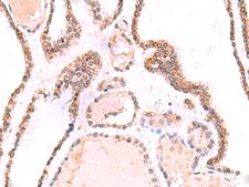 TOR1AIP1 / LAP1 Antibody - Immunohistochemistry of paraffin-embedded Human thyroid cancer tissue  using TOR1AIP1 Polyclonal Antibody at dilution of 1:70(×200)