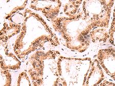 TOR1AIP1 / LAP1 Antibody - Immunohistochemistry of paraffin-embedded Human thyroid cancer tissue  using TOR1AIP1 Polyclonal Antibody at dilution of 1:60(×200)