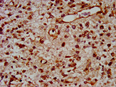 TOX Antibody - IHC image of TOX Antibody diluted at 1:400 and staining in paraffin-embedded human glioma performed on a Leica BondTM system. After dewaxing and hydration, antigen retrieval was mediated by high pressure in a citrate buffer (pH 6.0). Section was blocked with 10% normal goat serum 30min at RT. Then primary antibody (1% BSA) was incubated at 4°C overnight. The primary is detected by a biotinylated secondary antibody and visualized using an HRP conjugated SP system.