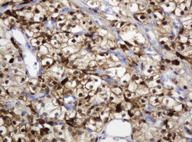 TP / Thymidine Phosphorylase Antibody - IHC of paraffin-embedded Carcinoma of Human kidney tissue using anti-TYMP mouse monoclonal antibody.