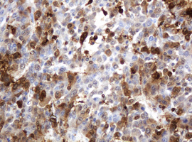 TP / Thymidine Phosphorylase Antibody - IHC of paraffin-embedded Carcinoma of Human liver tissue using anti-TYMP mouse monoclonal antibody.