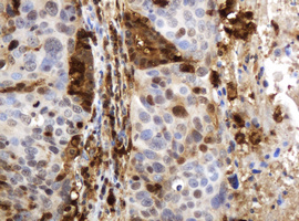 TP / Thymidine Phosphorylase Antibody - IHC of paraffin-embedded Carcinoma of Human lung tissue using anti-TYMP mouse monoclonal antibody.