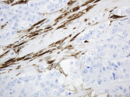 TP / Thymidine Phosphorylase Antibody - IHC of paraffin-embedded Adenocarcinoma of Human colon tissue using anti-TYMP mouse monoclonal antibody. (Heat-induced epitope retrieval by 10mM citric buffer, pH6.0, 120°C for 3min).