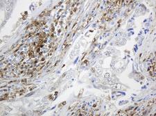 TP / Thymidine Phosphorylase Antibody - IHC of paraffin-embedded Adenocarcinoma of Human breast tissue using anti-TYMP mouse monoclonal antibody. (Heat-induced epitope retrieval by 10mM citric buffer, pH6.0, 120°C for 3min).