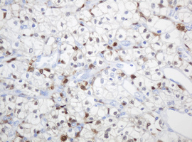 TP / Thymidine Phosphorylase Antibody - IHC of paraffin-embedded Carcinoma of Human kidney tissue using anti-TYMP mouse monoclonal antibody. (Heat-induced epitope retrieval by 10mM citric buffer, pH6.0, 120°C for 3min).