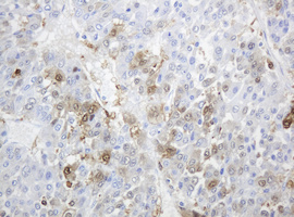 TP / Thymidine Phosphorylase Antibody - IHC of paraffin-embedded Carcinoma of Human liver tissue using anti-TYMP mouse monoclonal antibody. (Heat-induced epitope retrieval by 10mM citric buffer, pH6.0, 120°C for 3min).