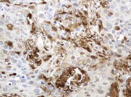 TP / Thymidine Phosphorylase Antibody - IHC of paraffin-embedded Carcinoma of Human lung tissue using anti-TYMP mouse monoclonal antibody. (Heat-induced epitope retrieval by 10mM citric buffer, pH6.0, 120°C for 3min).