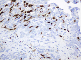 TP / Thymidine Phosphorylase Antibody - IHC of paraffin-embedded Adenocarcinoma of Human ovary tissue using anti-TYMP mouse monoclonal antibody. (Heat-induced epitope retrieval by 10mM citric buffer, pH6.0, 120°C for 3min).