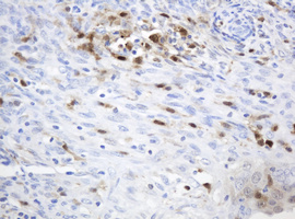 TP / Thymidine Phosphorylase Antibody - IHC of paraffin-embedded Adenocarcinoma of Human endometrium tissue using anti-TYMP mouse monoclonal antibody. (Heat-induced epitope retrieval by 10mM citric buffer, pH6.0, 120°C for 3min).