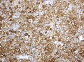 TP / Thymidine Phosphorylase Antibody - IHC of paraffin-embedded Human lymphoma tissue using anti-TYMP mouse monoclonal antibody. (Heat-induced epitope retrieval by 10mM citric buffer, pH6.0, 120°C for 3min).