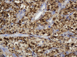 TP / Thymidine Phosphorylase Antibody - IHC of paraffin-embedded Carcinoma of Human kidney tissue using anti-TYMP mouse monoclonal antibody.