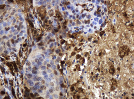 TP / Thymidine Phosphorylase Antibody - IHC of paraffin-embedded Carcinoma of Human lung tissue using anti-TYMP mouse monoclonal antibody.