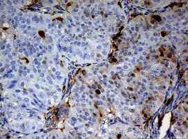 TP / Thymidine Phosphorylase Antibody - IHC of paraffin-embedded Adenocarcinoma of Human ovary tissue using anti-TYMP mouse monoclonal antibody.