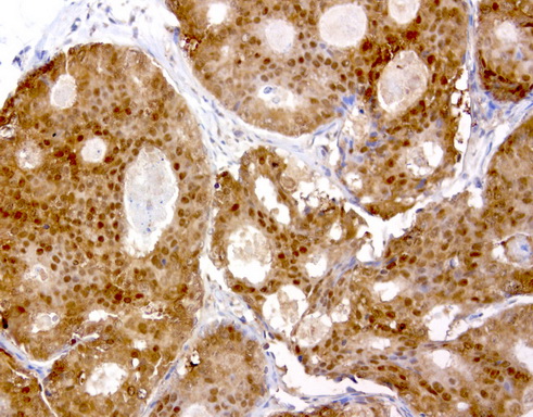 TP / Thymidine Phosphorylase Antibody - Immunohistochemical staining of paraffin-embedded human breast cancer using anti-TYMP clone UMAB90 mouse monoclonal antibody  at 1:200 with Polink2 Broad HRP DAB detection kit; heat-induced epitope retrieval with GBI Citrate pH6.0 HIER buffer us
