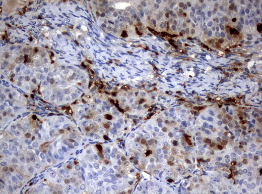 TP / Thymidine Phosphorylase Antibody - Immunohistochemical staining of paraffin-embedded Adenocarcinoma of Human ovary tissue using anti-TYMP mouse monoclonal antibody.  heat-induced epitope retrieval by 10mM citric buffer, pH6.0, 120C for 3min)
