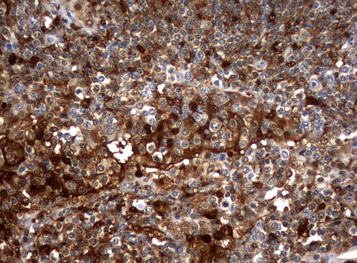 TP / Thymidine Phosphorylase Antibody - Immunohistochemical staining of paraffin-embedded Human lymphoma tissue using anti-TYMP mouse monoclonal antibody.  heat-induced epitope retrieval by 10mM citric buffer, pH6.0, 120C for 3min)