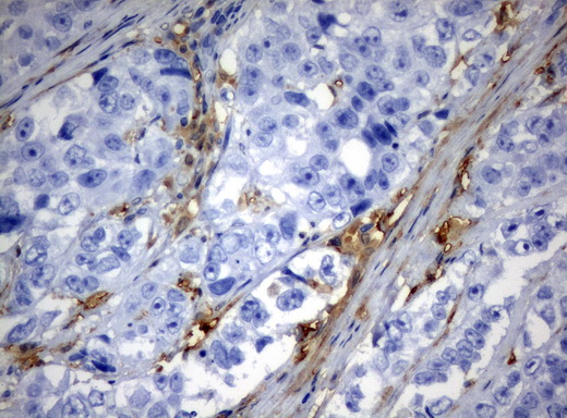 TP / Thymidine Phosphorylase Antibody - Immunohistochemical staining of paraffin-embedded Adenocarcinoma of Human colon tissue using anti-TYMP mouse monoclonal antibody.  heat-induced epitope retrieval by 10mM citric buffer, pH6.0, 120C for 3min)