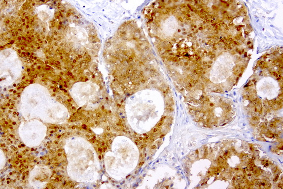 TP / Thymidine Phosphorylase Antibody - Immunohistochemical staining of paraffin-embedded human breast cancer using anti-TYMP clone UMAB97 mouse monoclonal antibody  at 1:200 with Polink2 Broad HRP DAB detection kit; heat-induced epitope retrieval with GBI Citrate pH6.0 HIER buffer us