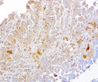TP / Thymidine Phosphorylase Antibody - Immunohistochemical staining of paraffin-embedded human gastric cancer using anti-TYMP clone UMAB97 mouse monoclonal antibody  at 1:200 with Polink2 Broad HRP DAB detection kit; heat-induced epitope retrieval with GBI Citrate pH6.0 HIER buffer u