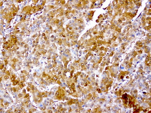 TP / Thymidine Phosphorylase Antibody - Immunohistochemical staining of paraffin-embedded human liver cancer using anti-TYMP clone UMAB97 mouse monoclonal antibody  at 1:200 with Polink2 Broad HRP DAB detection kit; heat-induced epitope retrieval with GBI Citrate pH6.0 HIER buffer usi