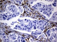 TP / Thymidine Phosphorylase Antibody - Immunohistochemical staining of paraffin-embedded Carcinoma of Human bladder tissue using anti-TYMP mouse monoclonal antibody.  heat-induced epitope retrieval by 10mM citric buffer, pH6.0, 120C for 3min)