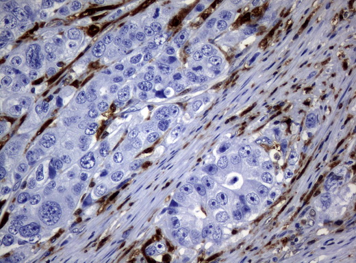 TP / Thymidine Phosphorylase Antibody - Immunohistochemical staining of paraffin-embedded Adenocarcinoma of Human colon tissue using anti-TYMPmouse monoclonal antibody.  heat-induced epitope retrieval by 10mM citric buffer, pH6.0, 120C for 3min)