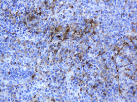 TP / Thymidine Phosphorylase Antibody - IHC of paraffin-embedded Human lymphoma tissue using anti-TYMP mouse monoclonal antibody.