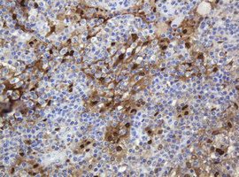 TP / Thymidine Phosphorylase Antibody - IHC of paraffin-embedded Human lymphoma tissue using anti-TYMP mouse monoclonal antibody.