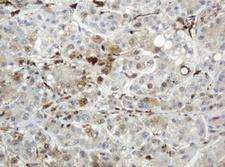 TP / Thymidine Phosphorylase Antibody - IHC of paraffin-embedded Carcinoma of Human liver tissue using anti-TYMP mouse monoclonal antibody.