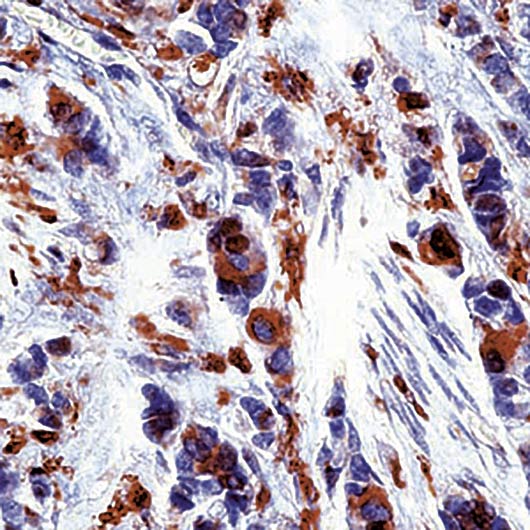 TP / Thymidine Phosphorylase Antibody - Formalin-fixed, paraffin-embedded human breast carcinoma stained with Thymidine Phosphorylase antibody.