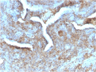 TP / Thymidine Phosphorylase Antibody - Formalin-fixed, paraffin-embedded human Prostate Carcinoma stained with Thymidine Phosphorylase Rabbit Recombinant Monoclonal (TYMP/2890R).