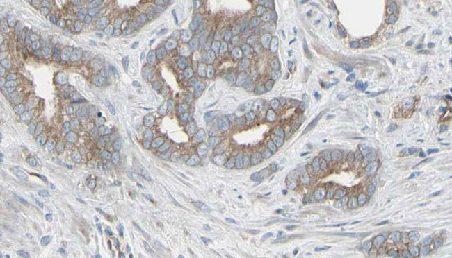 TP / Thymidine Phosphorylase Antibody - 1:100 staining human prostate tissue by IHC-P. The sample was formaldehyde fixed and a heat mediated antigen retrieval step in citrate buffer was performed. The sample was then blocked and incubated with the antibody for 1.5 hours at 22°C. An HRP conjugated goat anti-rabbit antibody was used as the secondary.