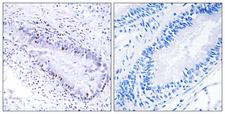 TP1 / TEP1 Antibody - Immunohistochemistry analysis of paraffin-embedded human lung carcinoma, using TEP1 Antibody. The picture on the right is blocked with the synthesized peptide.