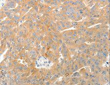 TP1 / TEP1 Antibody - Immunohistochemistry of paraffin-embedded Human thyroid cancer using TEP1 Polyclonal Antibody at dilution of 1:50.