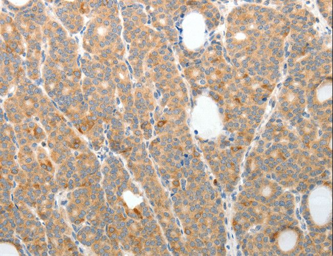 TP1 / TEP1 Antibody - Immunohistochemistry of paraffin-embedded Human thyroid cancer using TEP1 Polyclonal Antibody at dilution of 1:50.