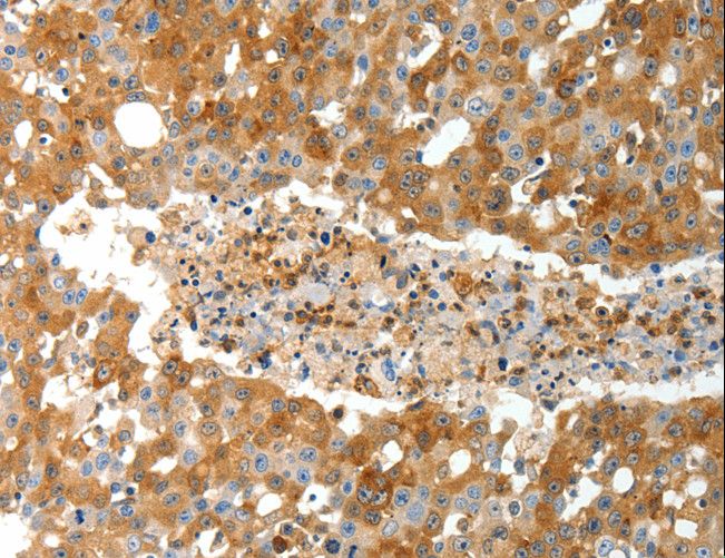 TP1 / TEP1 Antibody - Immunohistochemistry of paraffin-embedded Human gastric cancer using TEP1 Polyclonal Antibody at dilution of 1:40.