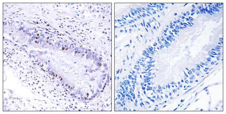 TP1 / TEP1 Antibody - Peptide - + Immunohistochemistry analysis of paraffin-embedded human lung carcinoma tissue, using TEP1 antibody.