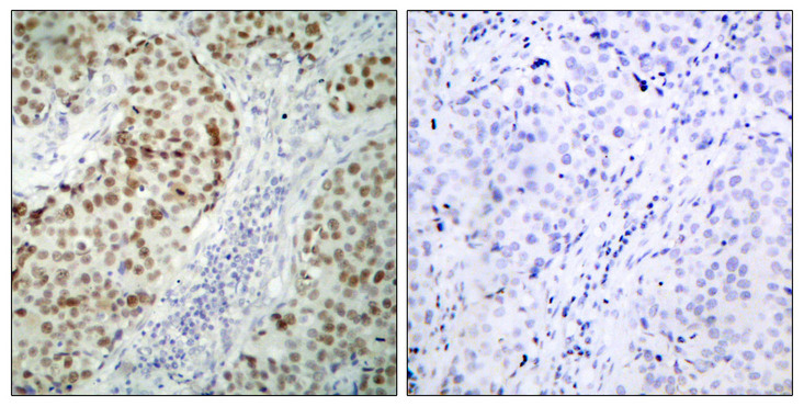 TP53 / p53 Antibody - Immunohistochemistry analysis of paraffin-embedded human breast carcinoma tissue, using p53 Antibody. The picture on the right is blocked with the synthesized peptide.