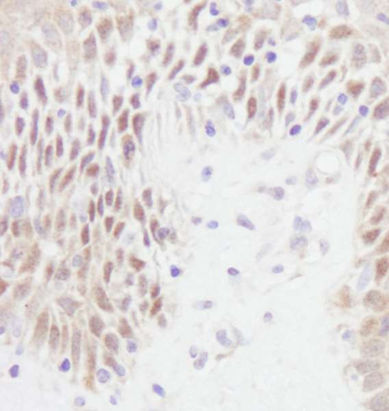 TP53 / p53 Antibody - Detection of Human p53 by Immunohistochemistry. Sample: FFPE section of human skin carcinoma. Antibody: Affinity purified rabbit anti-p53 used at a dilution of 1:1000 (1 ug/ml). Detection: DAB.