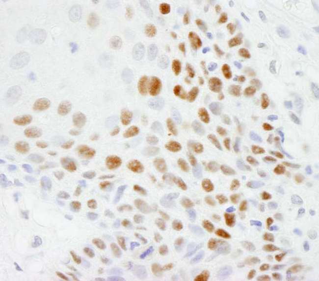 TP53 / p53 Antibody - Detection of Human p53 by Immunohistochemistry. Sample: FFPE section of human skin squamous cell carcinoma. Antibody: Affinity purified rabbit anti-p53 used at a dilution of 1:500. Detection: DAB.