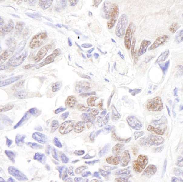TP53 / p53 Antibody - Detection of Human p53 by Immunohistochemistry. Sample: FFPE section of human lung adenocarcinoma. Antibody: Affinity purified rabbit anti-p53 used at a dilution of 1:500. Detection: DAB.