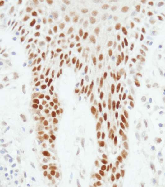 TP53 / p53 Antibody - Detection of Human p53 by Immunohistochemistry. Sample: FFPE section of human skin carcinoma. Antibody: Affinity purified rabbit anti-p53 used at a dilution of 1:1000 (1 ug/ml). Detection: DAB.