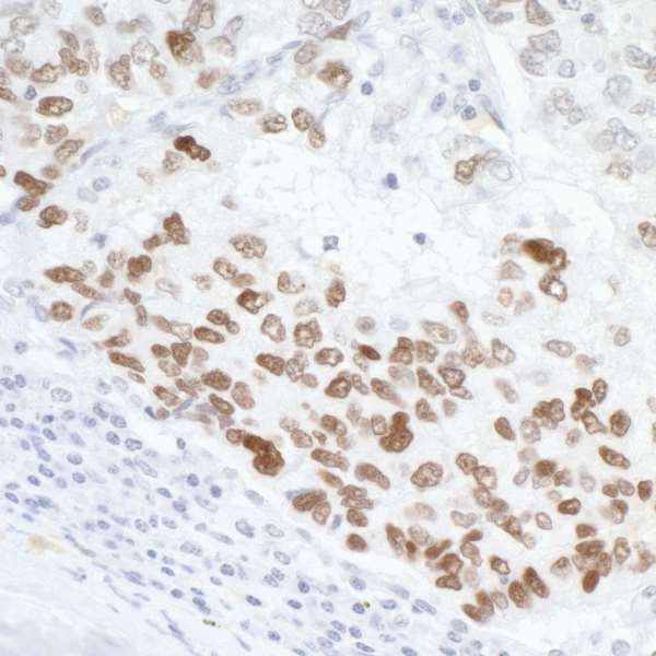 TP53 / p53 Antibody - Detection of human p53 by immunohistochemistry. Sample: FFPE section of human lung cancer Antibody: Affinity purified rabbit anti- p53 used at 1:5,000 (0.2µg/ml). Detection: DAB