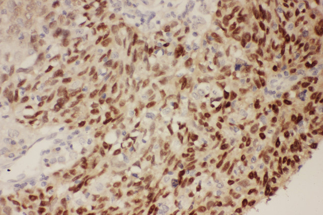 TP53 / p53 Antibody - TP53 / p53 antibody. IHC(P): Human Lung Cancer Tissue.