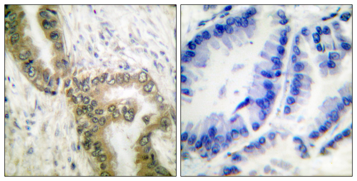 TP53 / p53 Antibody - Immunohistochemistry analysis of paraffin-embedded human lung carcinoma tissue, using p53 (Acetyl-Lys386) Antibody. The picture on the right is blocked with the synthesized peptide.