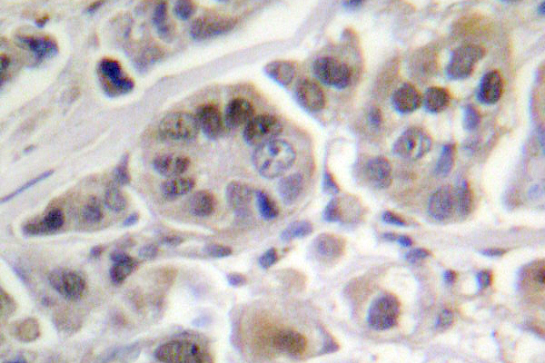 TP53 / p53 Antibody - IHC of p53 (R375) pAb in paraffin-embedded human lung carcinoma.